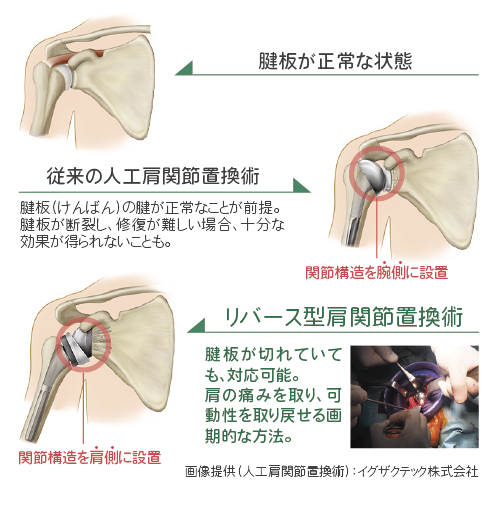 リバース型人工肩関節置換術